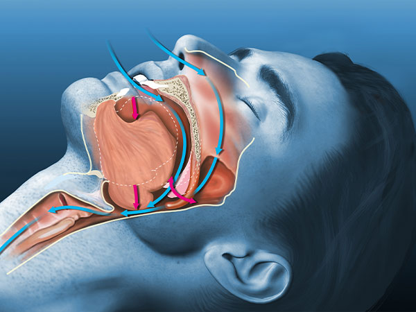睡眠時無呼吸症候群とは